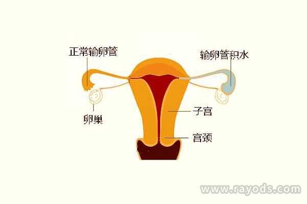 上海供卵试管助孕_输卵管积水真的是“水”吗？也许没那么简单